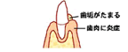 歯肉炎の図
