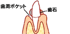 軽度歯周炎の図