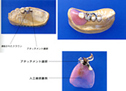 金属のフレームと強化プラスチックの歯の写真