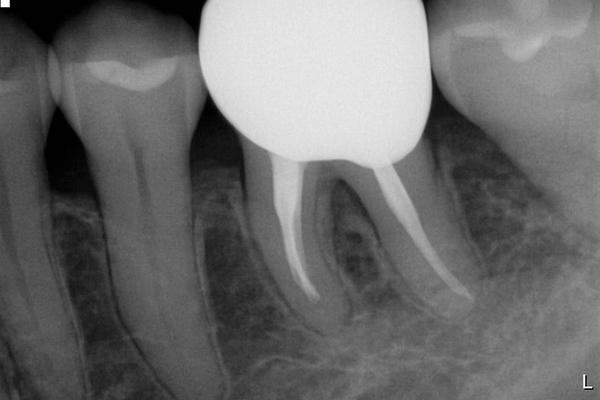リグロスによる歯周再生治療後1年
