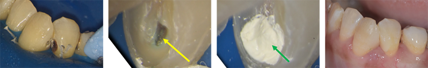 バイオセラミックス