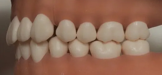 アングル分類 Ⅰ級