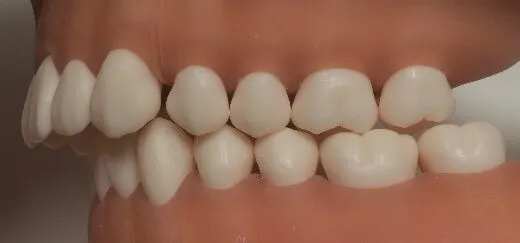 アングル分類 Ⅱ級