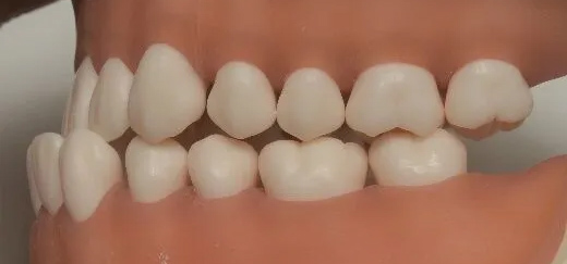 アングル分類 Ⅲ級