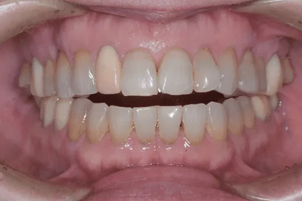 オープンバイト