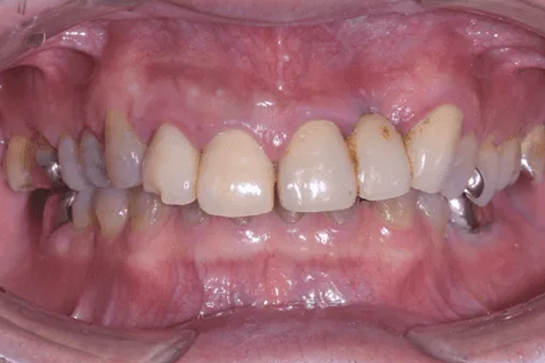 ディープバイト