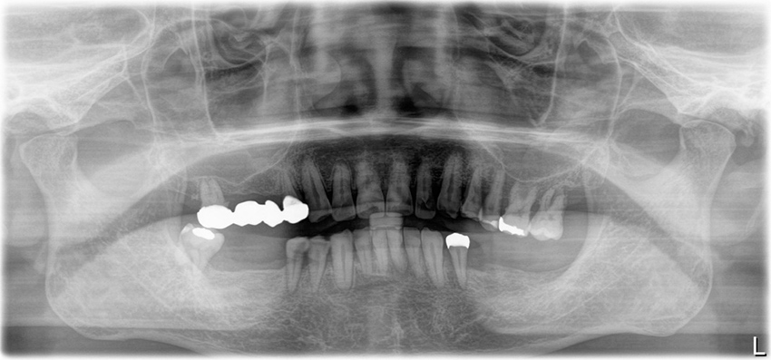 奥歯から順に、欠損になっていっている症例