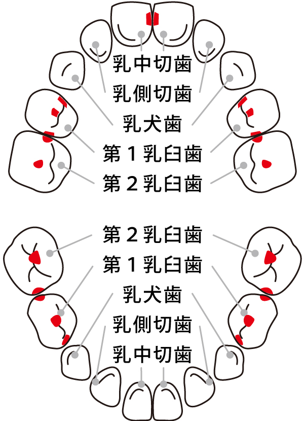乳歯がむし歯になったら
