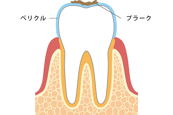 ペリクルとは、プラークができる原因