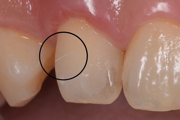 咬合によるクラック