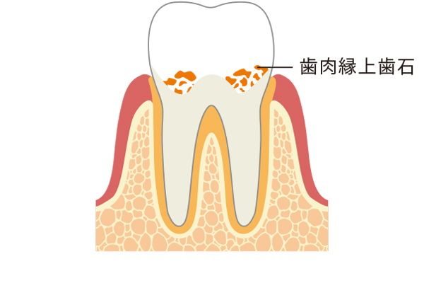 歯石ができる原因・機序
