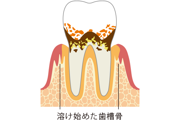 プラークによる毒素の産生