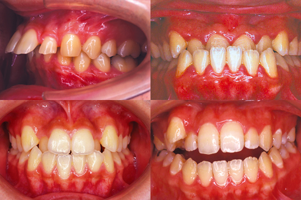 矯正が予防に繋がる訳