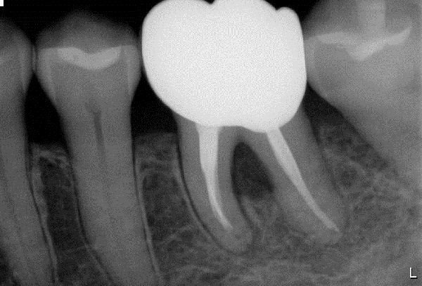 リグロスを使用する歯周病治療 04