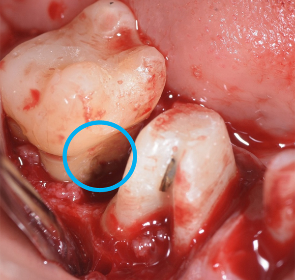 SRP（スケーリング・ルートプレーニング） 01