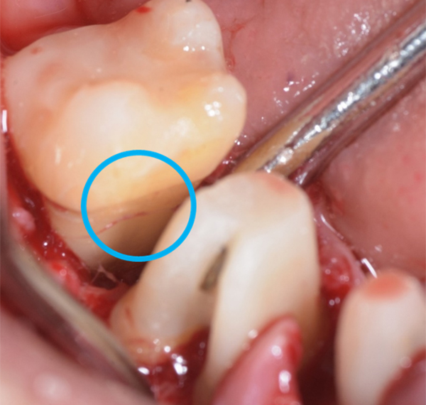 SRP（スケーリング・ルートプレーニング） 02