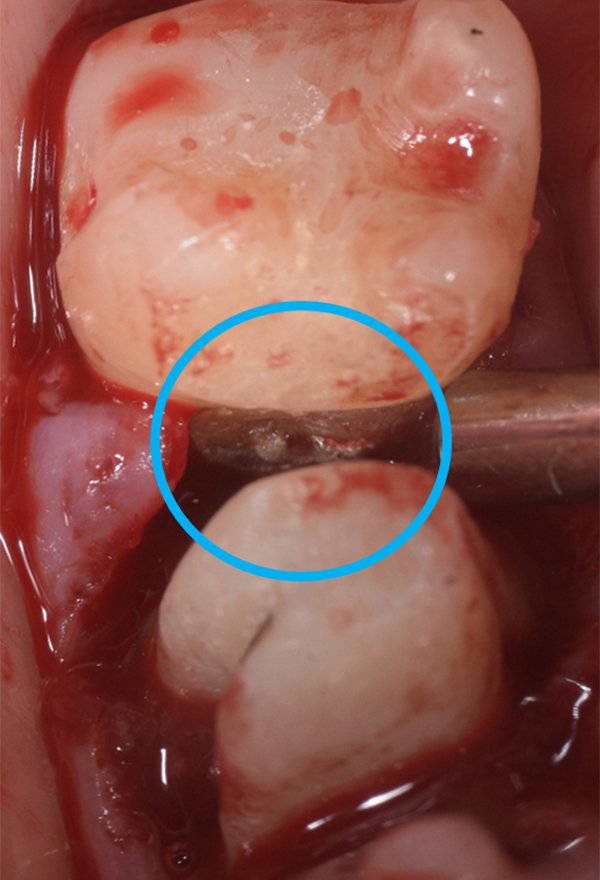歯肉剥離掻爬術 01