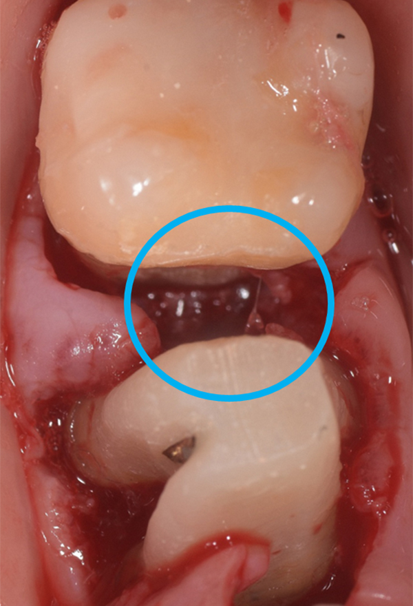 歯肉剥離掻爬術 02