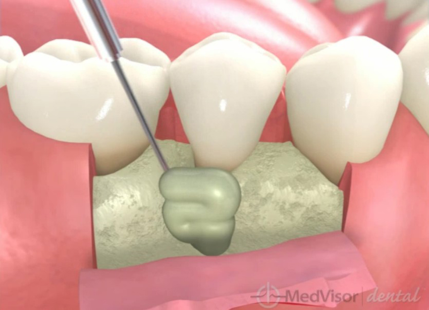 エムドゲインを使用した治療法 02