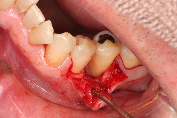 エムドゲインを使用した治療法 03