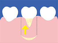 歯冠側移動術（CAF）1