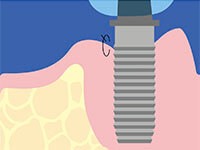 インプラント周囲炎に対する歯周再生治療2