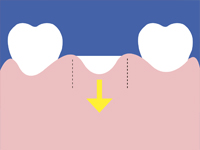 クラウンレングスニング1