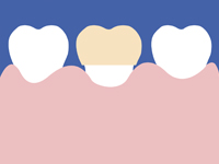 クラウンレングスニング2