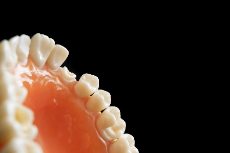 歯の欠損予防としての矯正