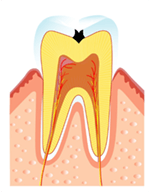C1(むし歯の第1段階）