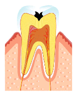 C2(むし歯の第2段階）