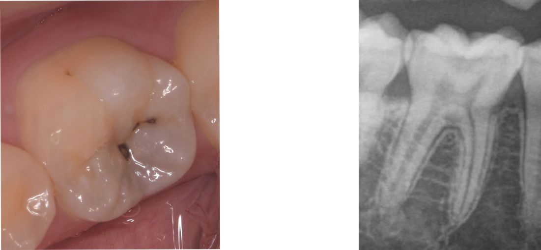 象牙質の層にまでむし歯が進行し、穴があいている状態