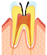 C３(むし歯の第３段階）