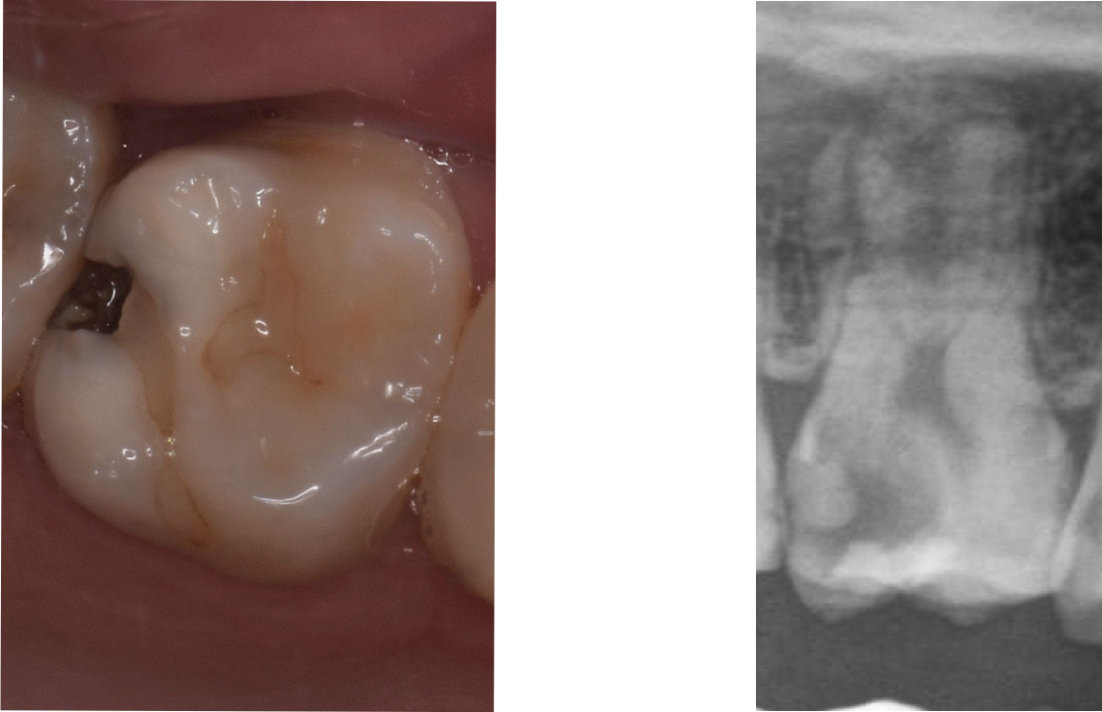 歯髄（神経）の層までむし歯が進行した状態