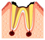 C4(むし歯の第4段階）