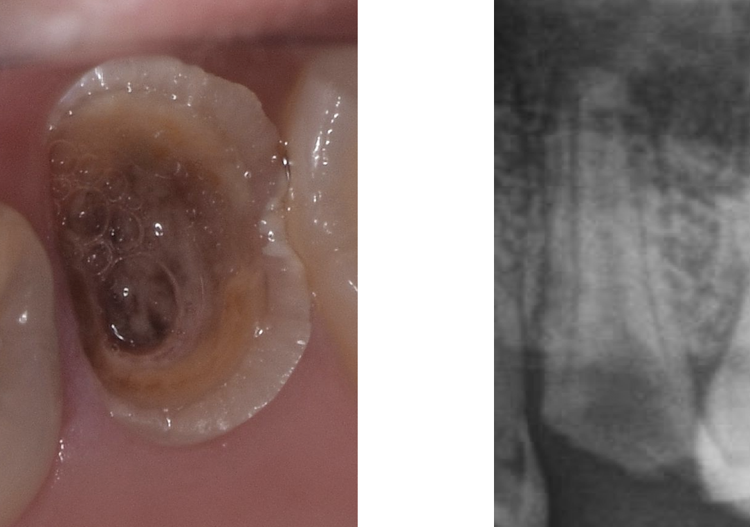 歯冠（歯の頭の部分）はむし歯によって失われ、根だけが残ってしまった状態