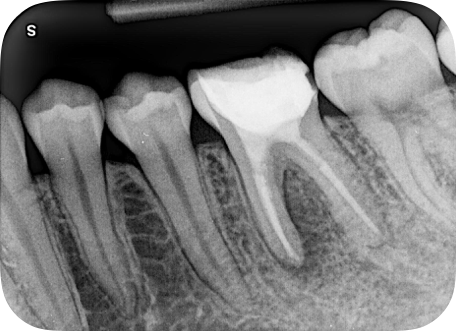 歯内治療とは「神経抜かれた！」という治療方法