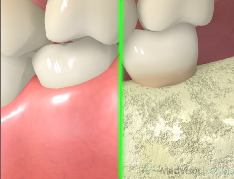 健康的な歯肉、歯槽骨の状態