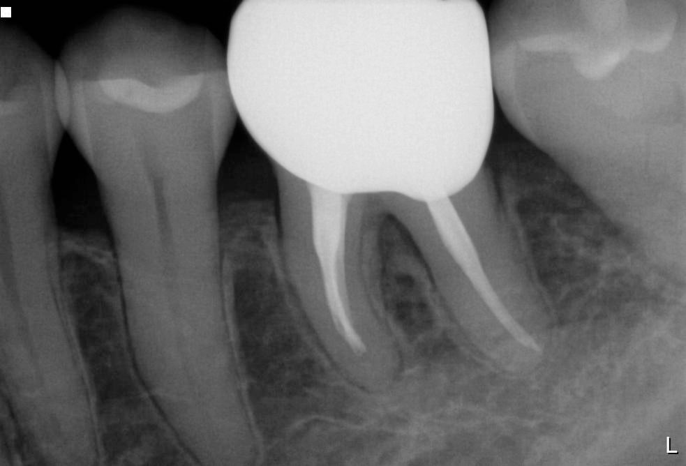 リグロスによる歯周再生治療後1年