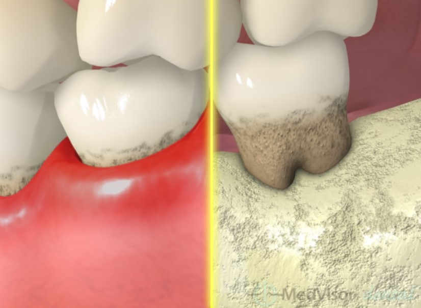 歯槽骨の吸収