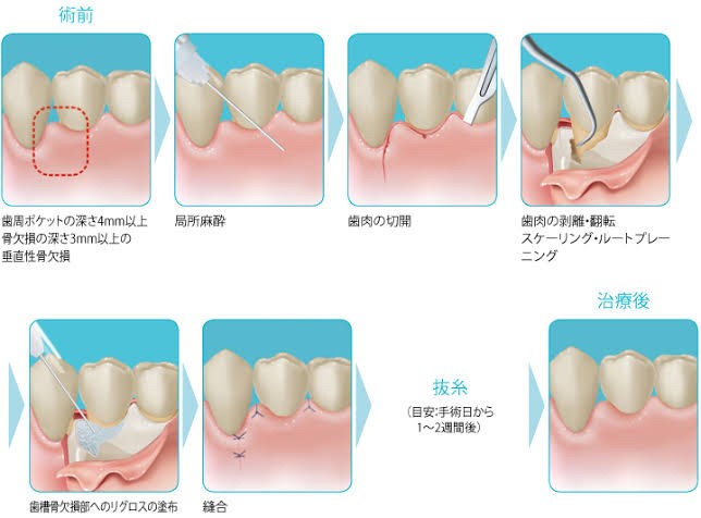 リグロスを使用する歯周病治療 01