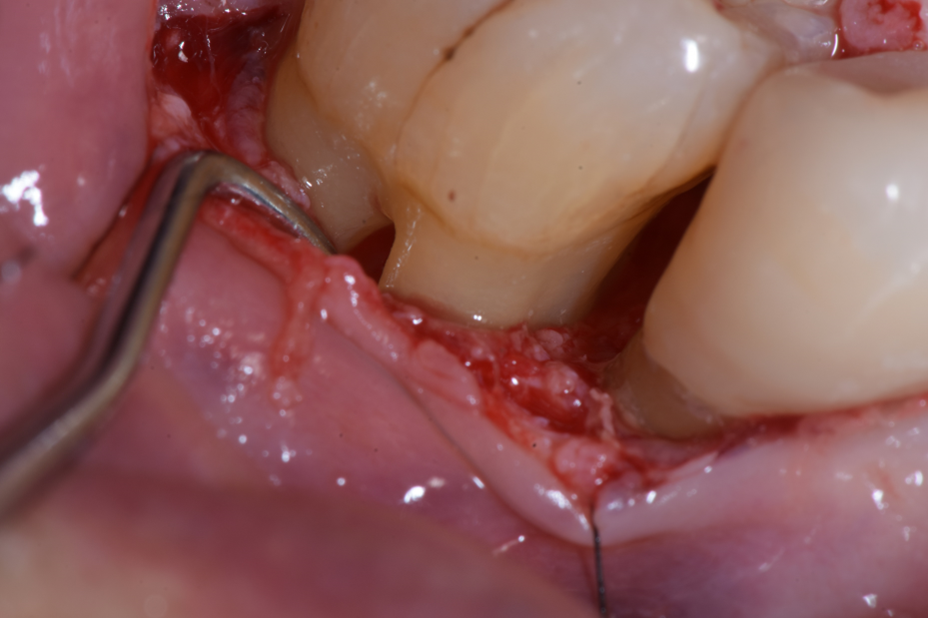リグロスを使用する歯周病治療 02