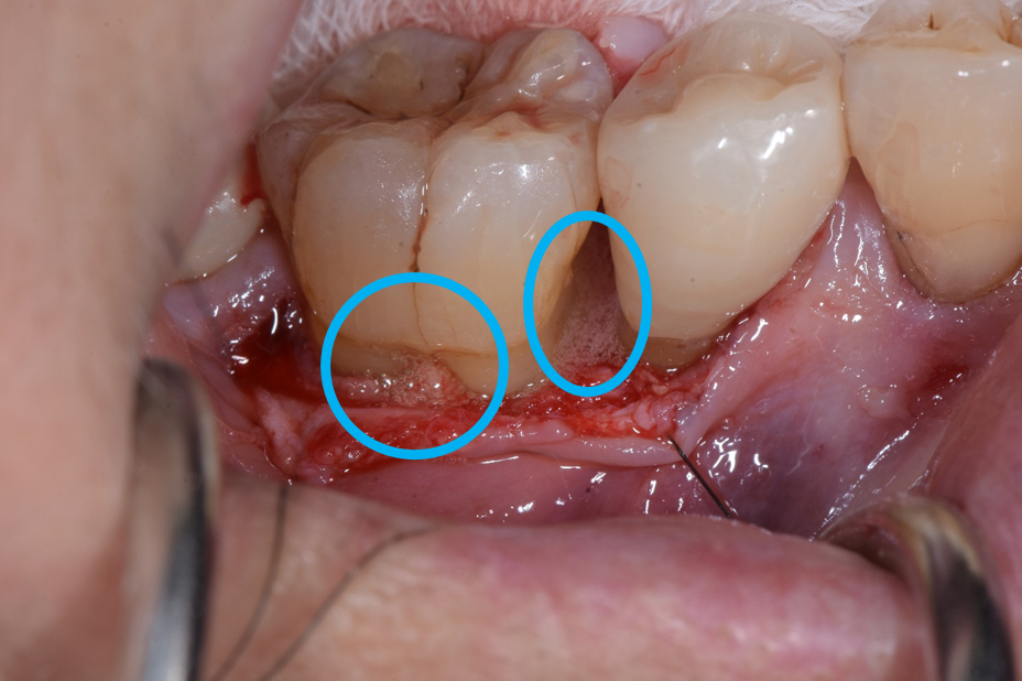 リグロスを使用する歯周病治療 03