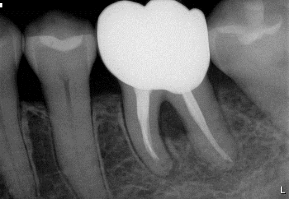 リグロスを使用する歯周病治療 04