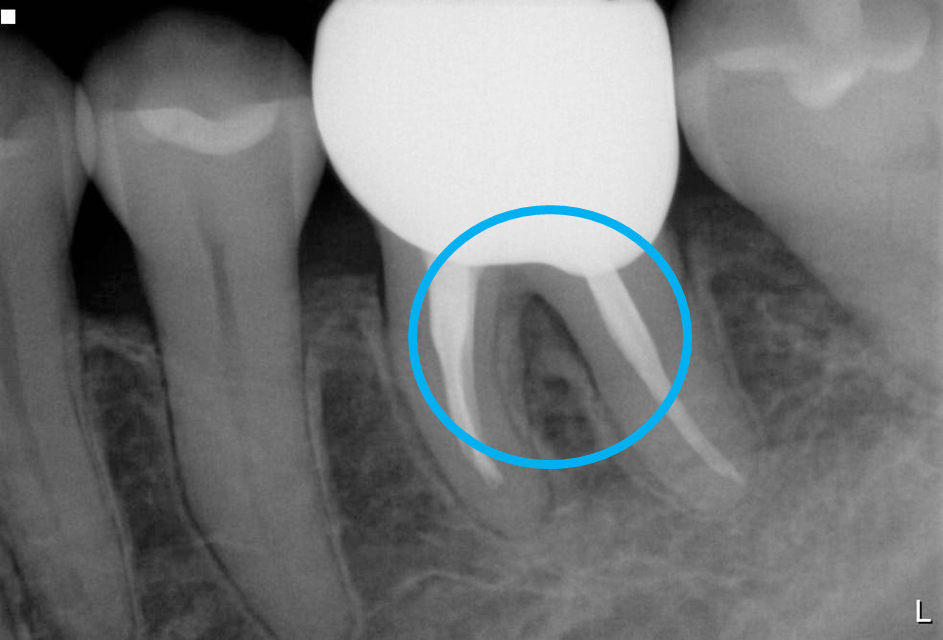 リグロスを使用する歯周病治療 05