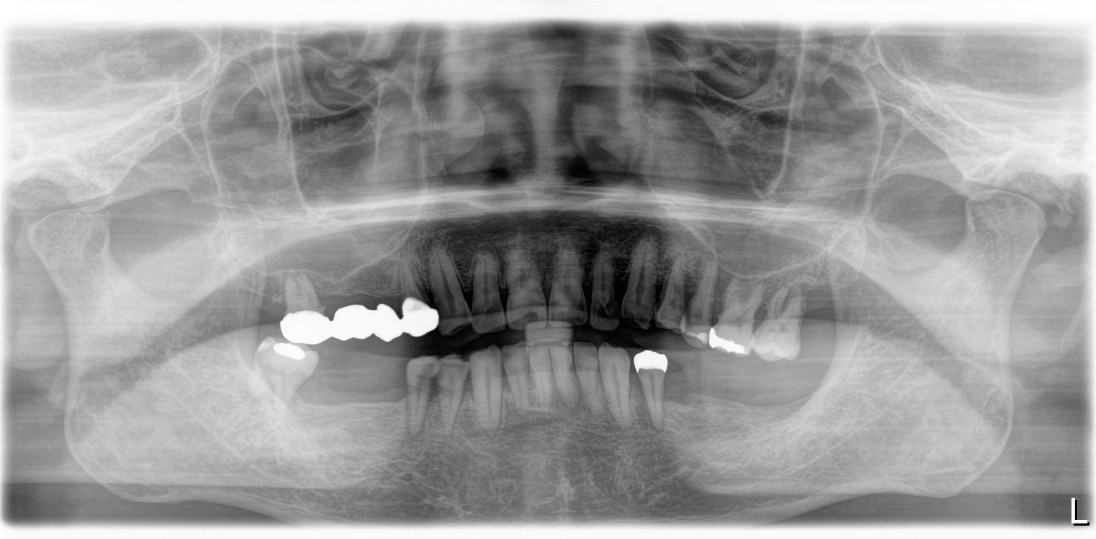 奥歯から順に、欠損になっていっている症例