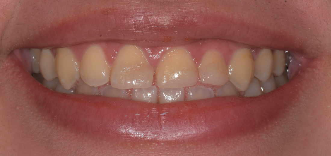 歯肉整形＋歯槽骨整形（クラウンレングスニング）＋補綴治療
