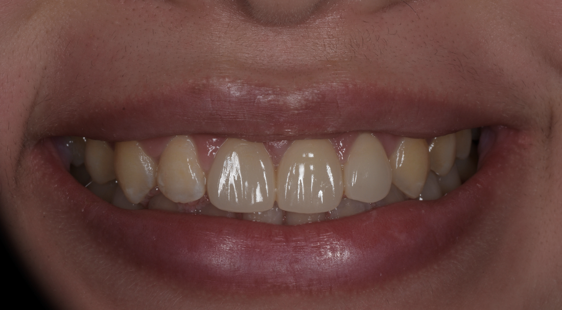 歯肉整形、歯槽骨整形（クラウンレングスニング）、矯正治療、上唇粘膜切除術、補綴治療