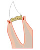 歯肉炎の図