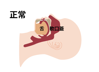 イラスト正常